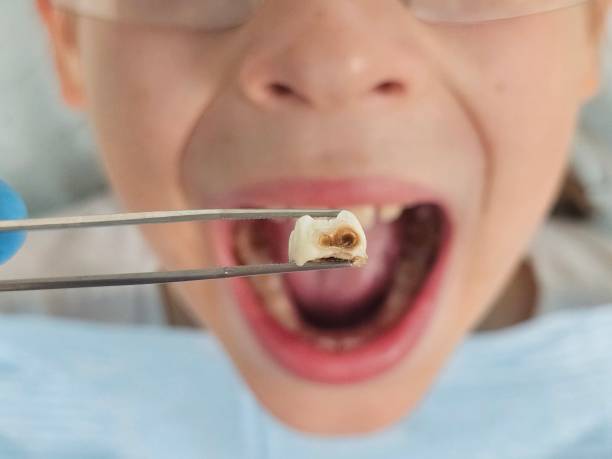 Best Emergency Tooth Extraction in Rouse, CA